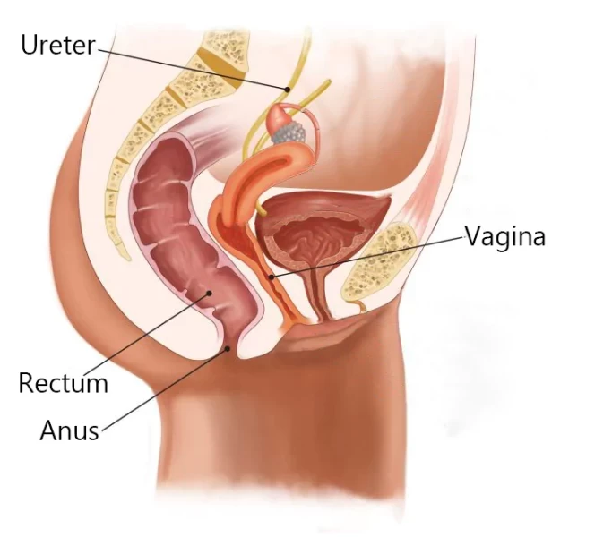 vaginoplasty