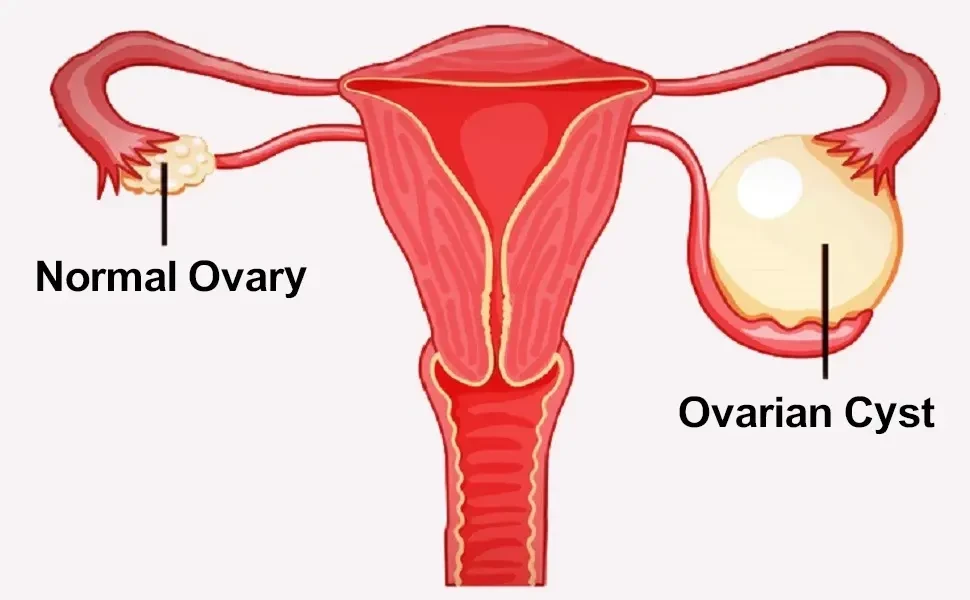 Best Doctor For Ovarian Cysts Treatment In Hyderabad