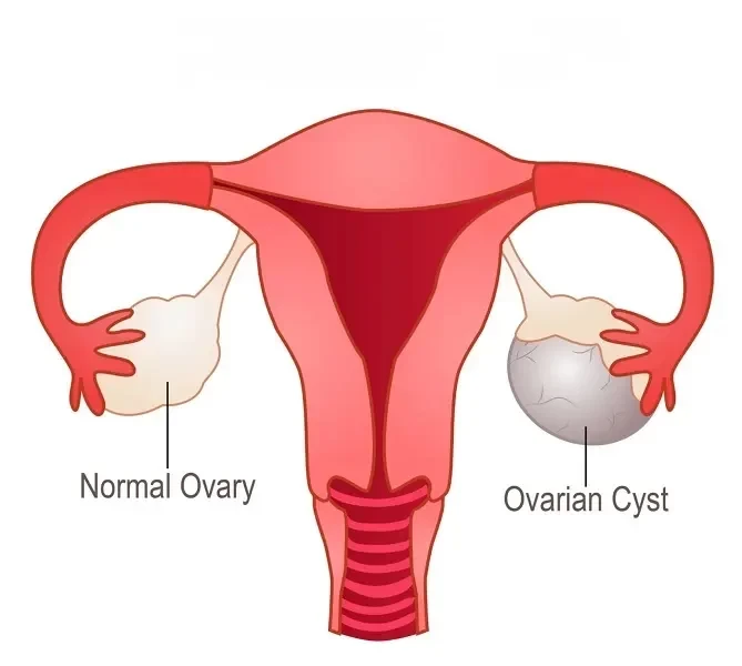 Ovarian Cystectomy